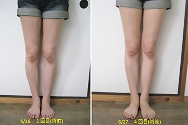 Before After①