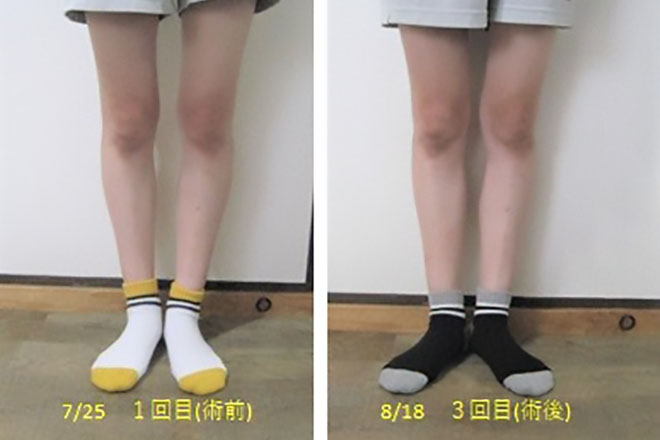 Before After③