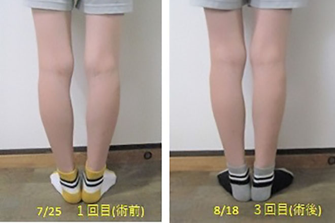 Before After④